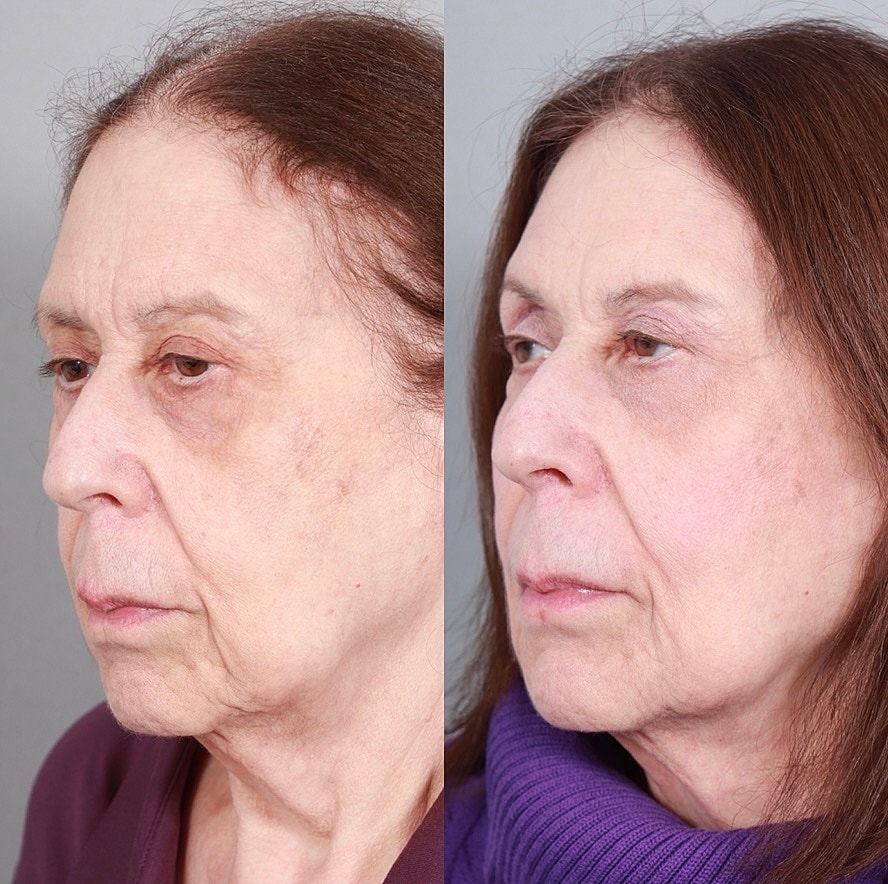Fillers Before & After
