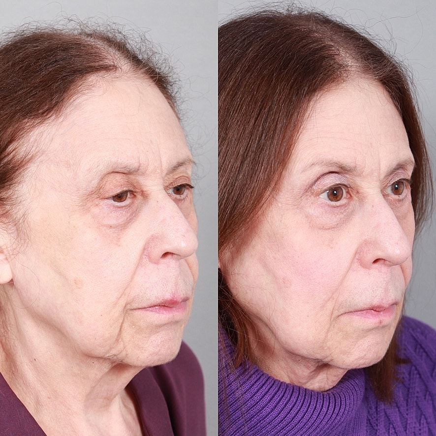 Fillers Before & After