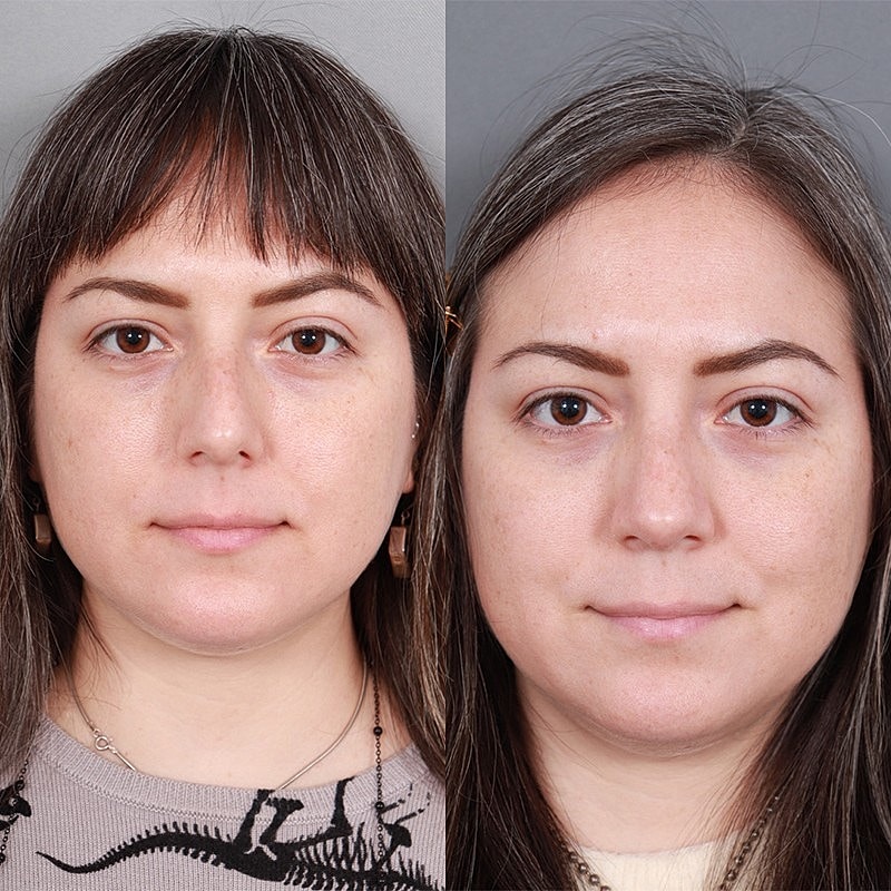 Rhinoplasty Before & After