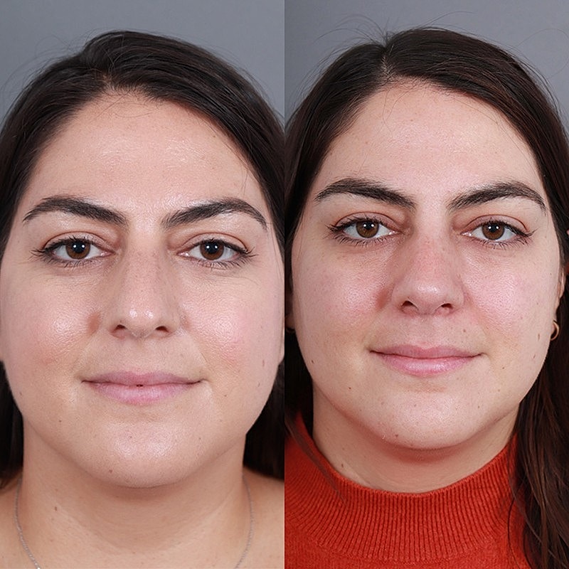 Rhinoplasty Before & After