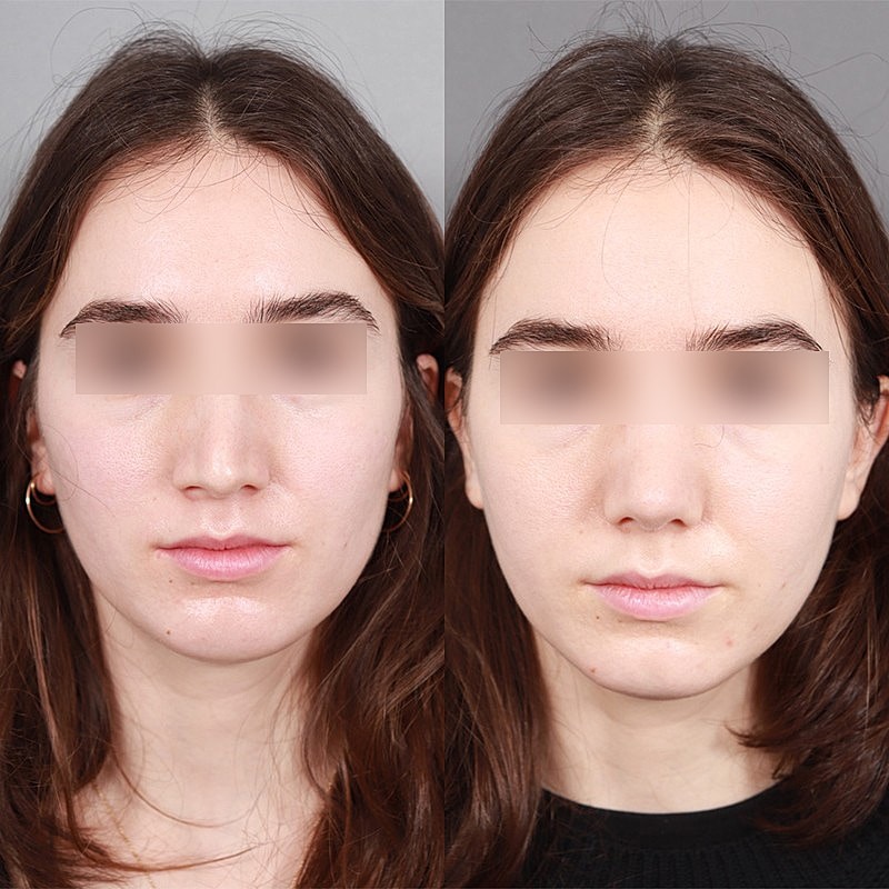 Rhinoplasty Before & After