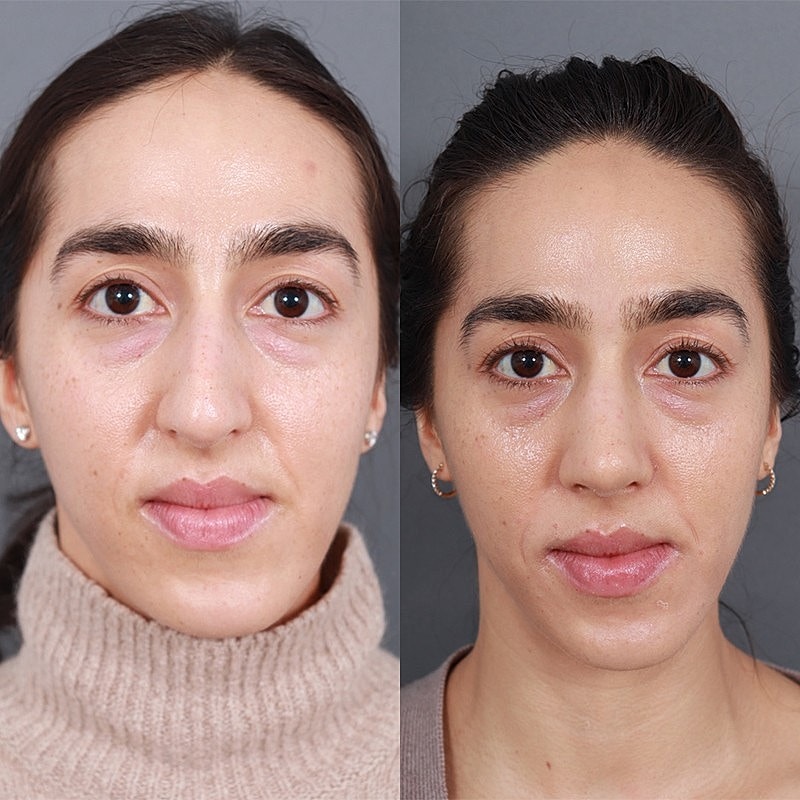 Rhinoplasty Before & After