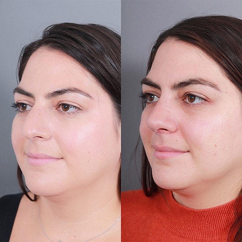 Rhinoplasty Before & After