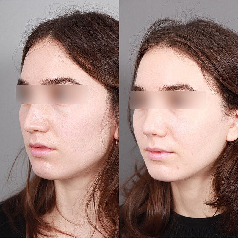 Rhinoplasty Before & After