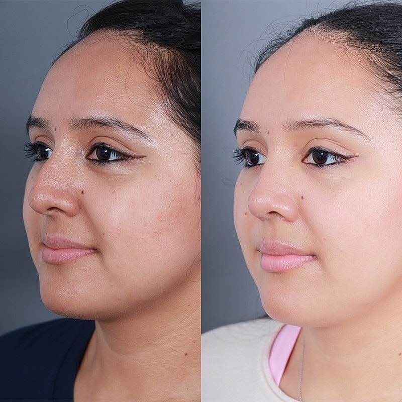 Rhinoplasty Before & After