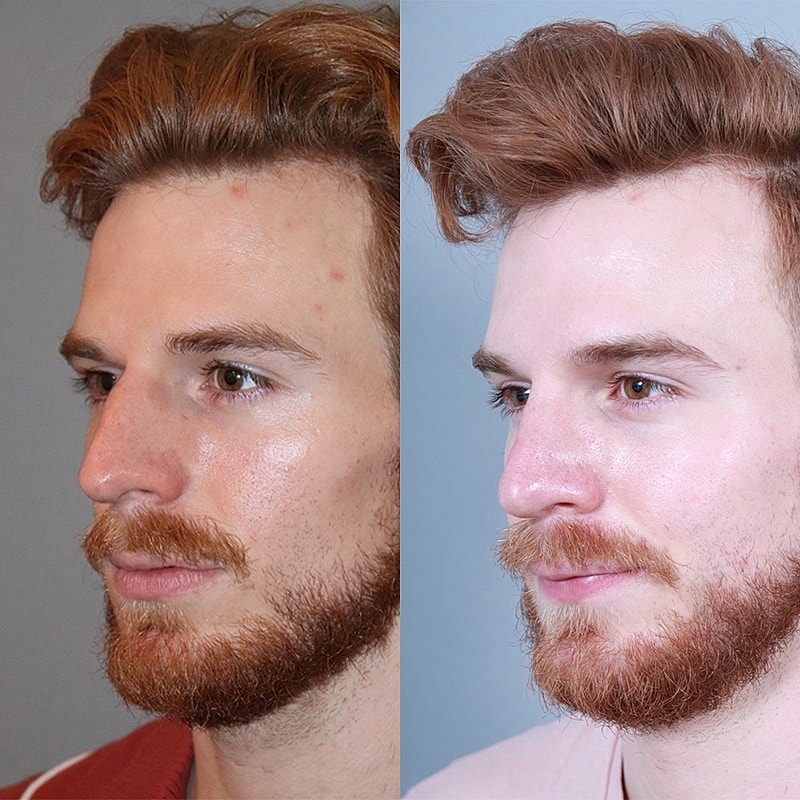 Rhinoplasty Before & After