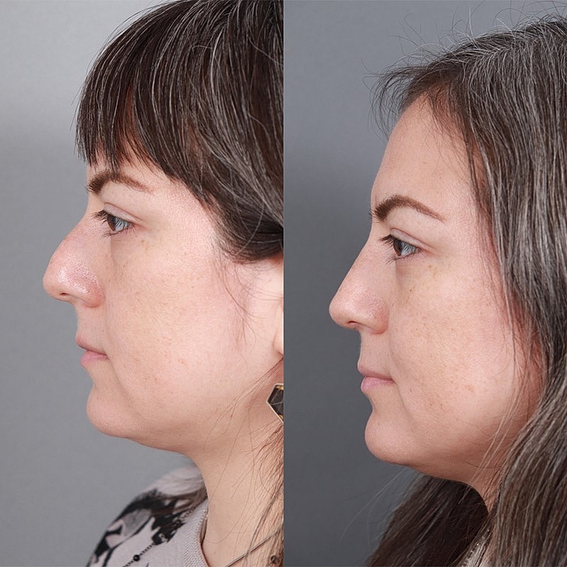 Rhinoplasty Before & After