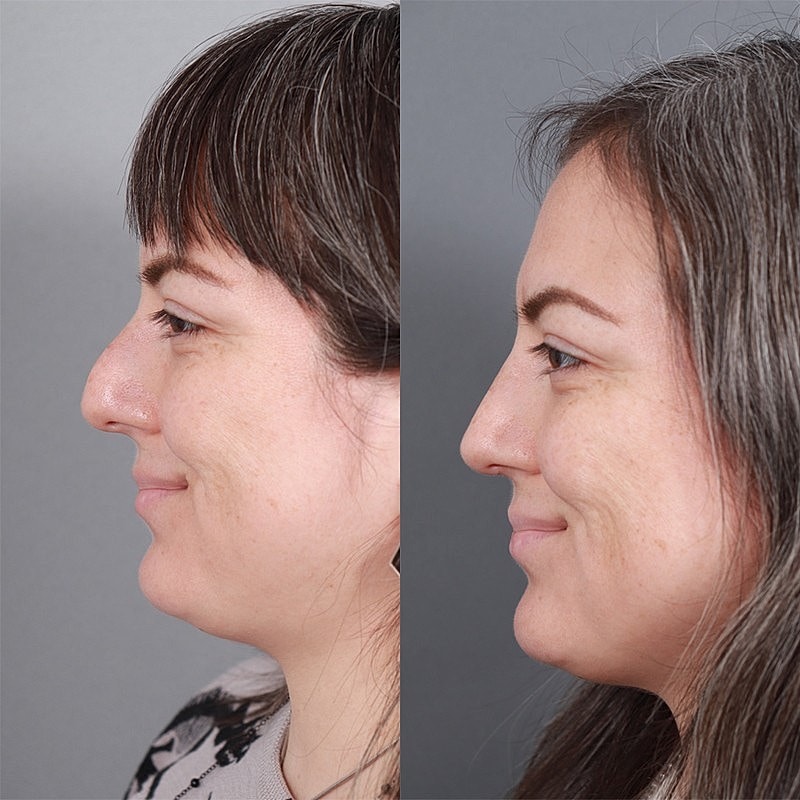 Rhinoplasty Before & After