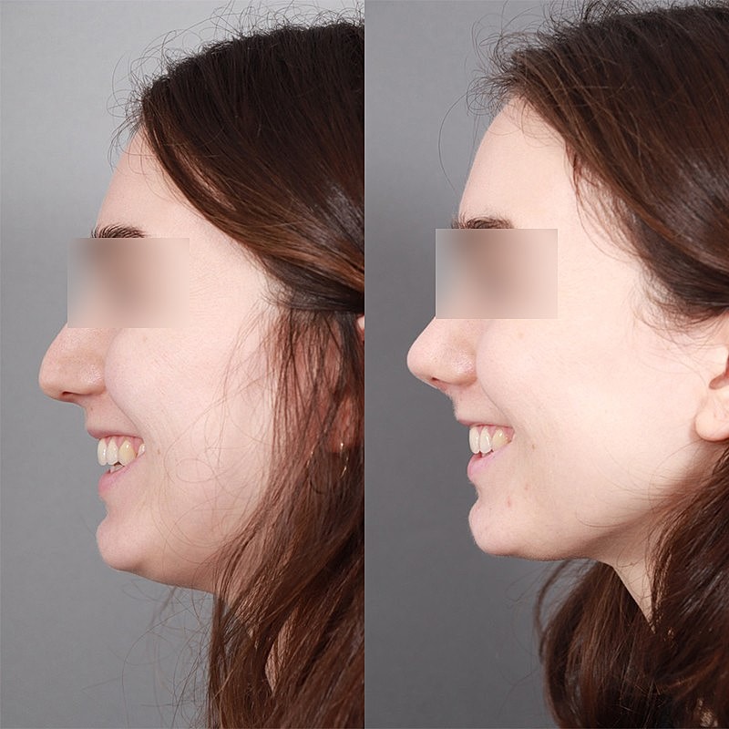 Rhinoplasty Before & After