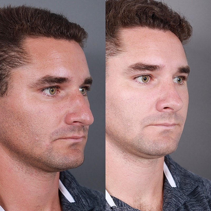Rhinoplasty Before & After