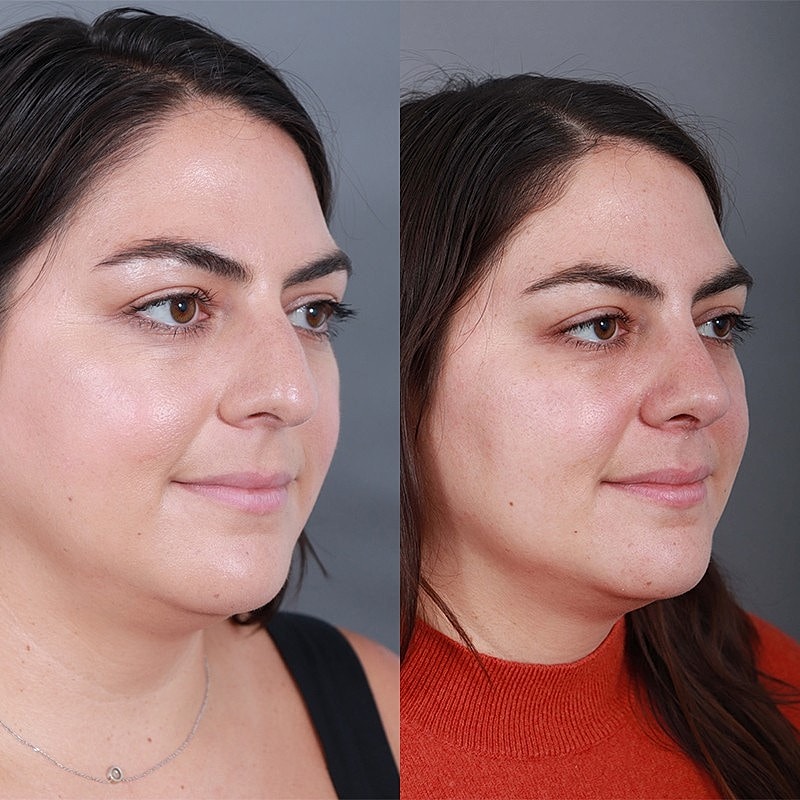 Rhinoplasty Before & After