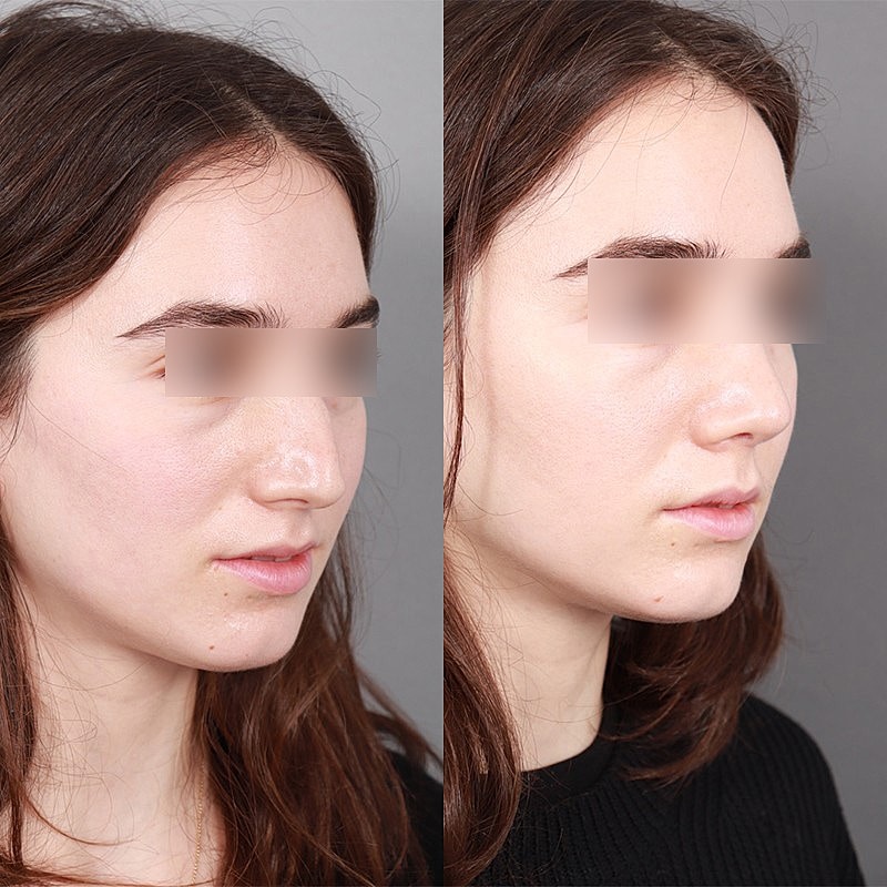 Rhinoplasty Before & After