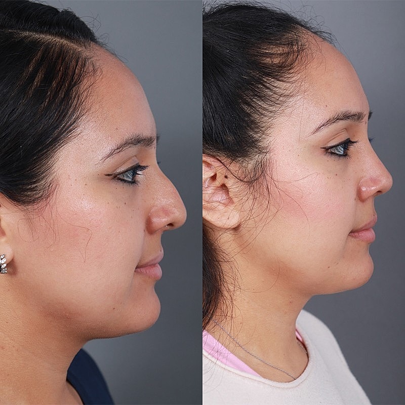 Rhinoplasty Before & After