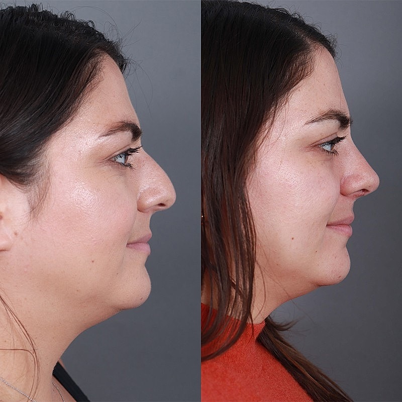 Rhinoplasty Before & After