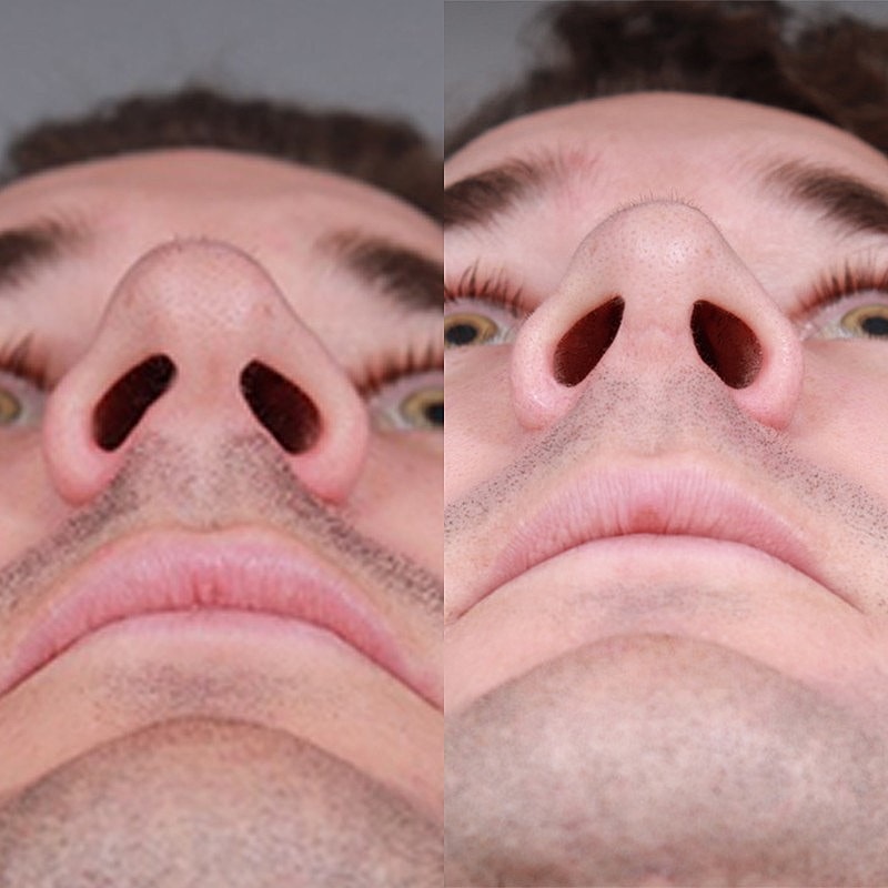 Rhinoplasty Before & After
