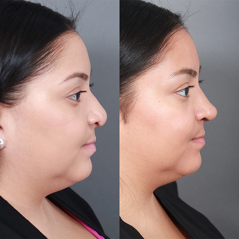 Rhinoplasty Before & After
