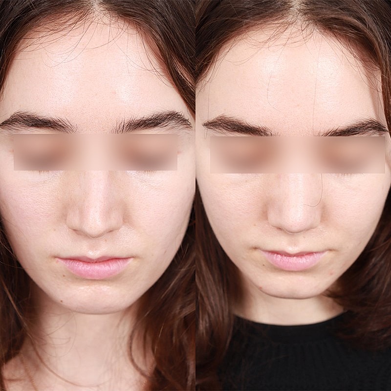 Rhinoplasty Before & After