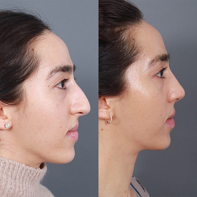 Rhinoplasty Before & After