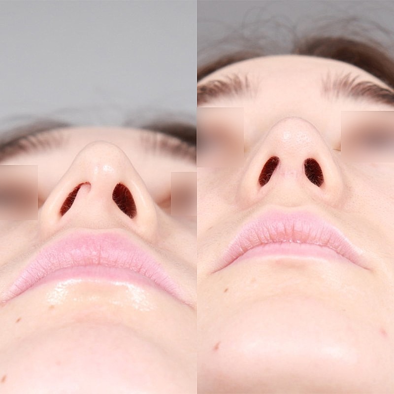 Rhinoplasty Before & After