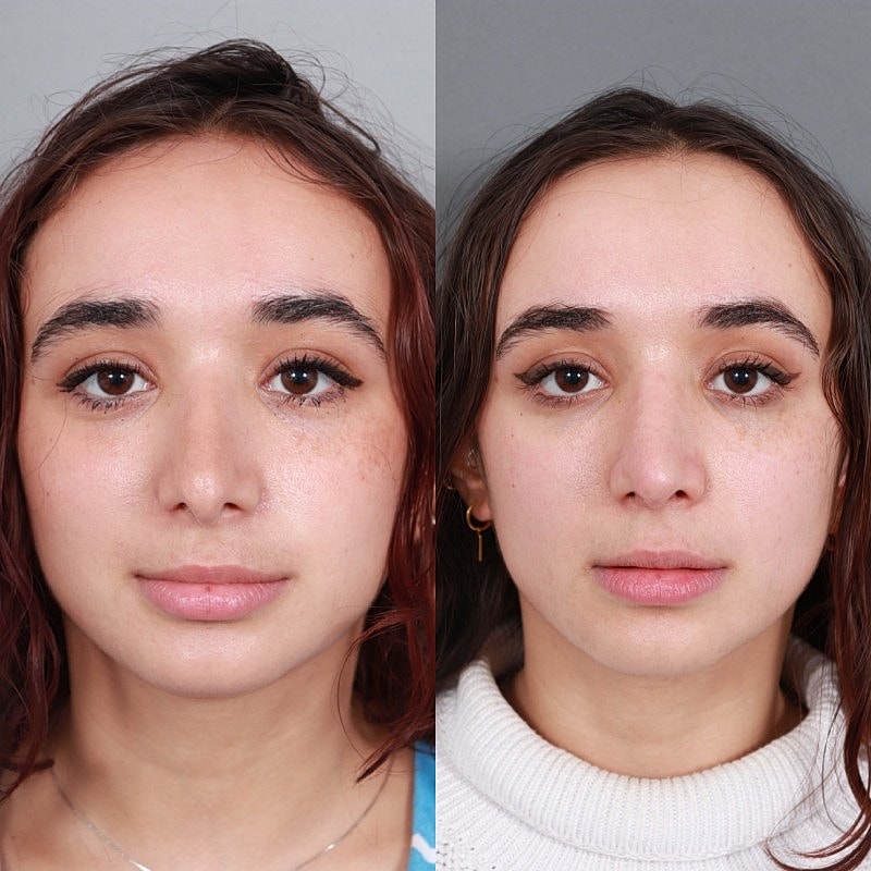 Before & After
