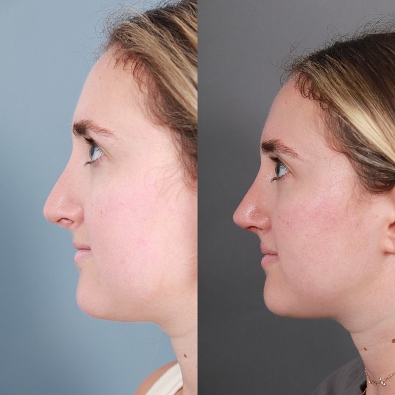 Before & After