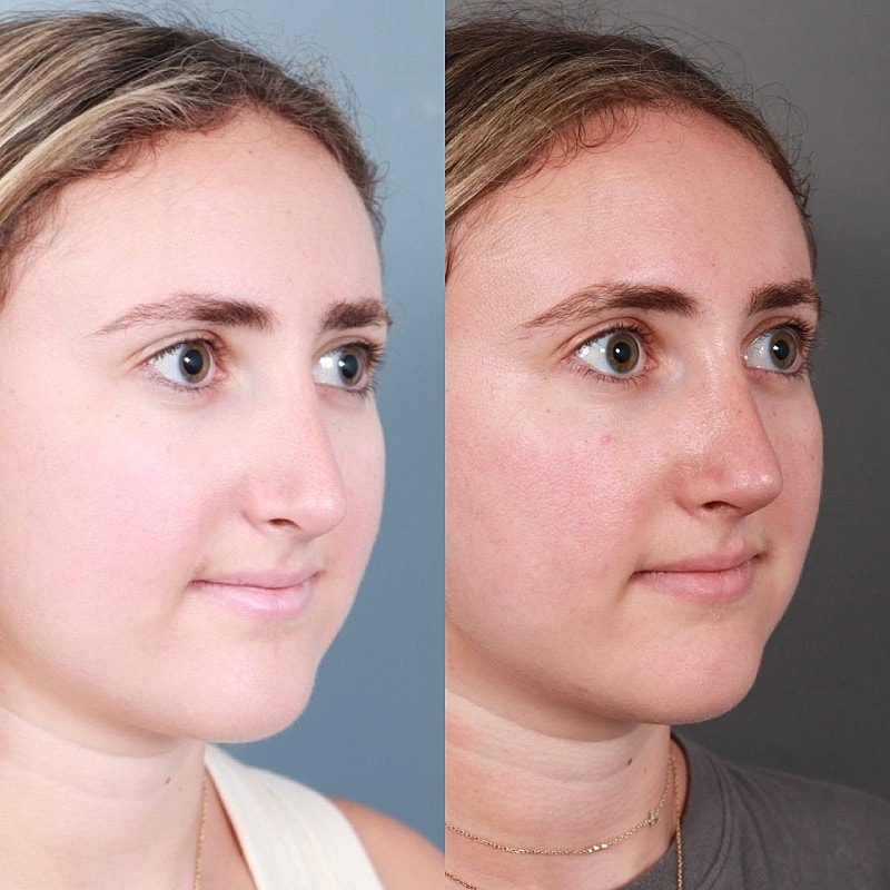 Before & After
