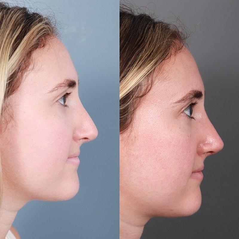 Before & After
