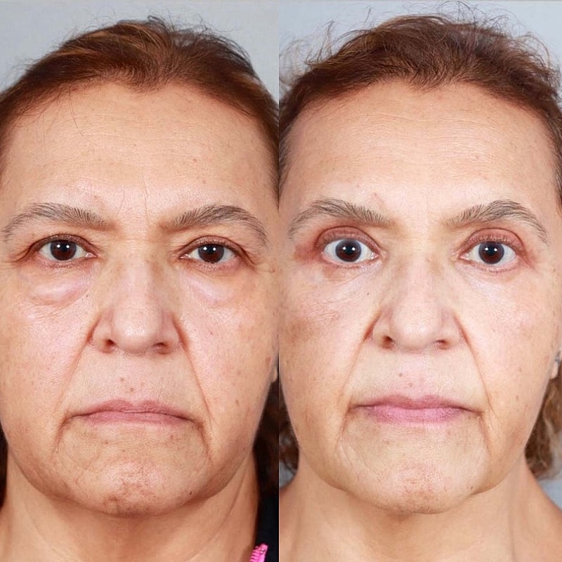 Blepharoplasty Before & After