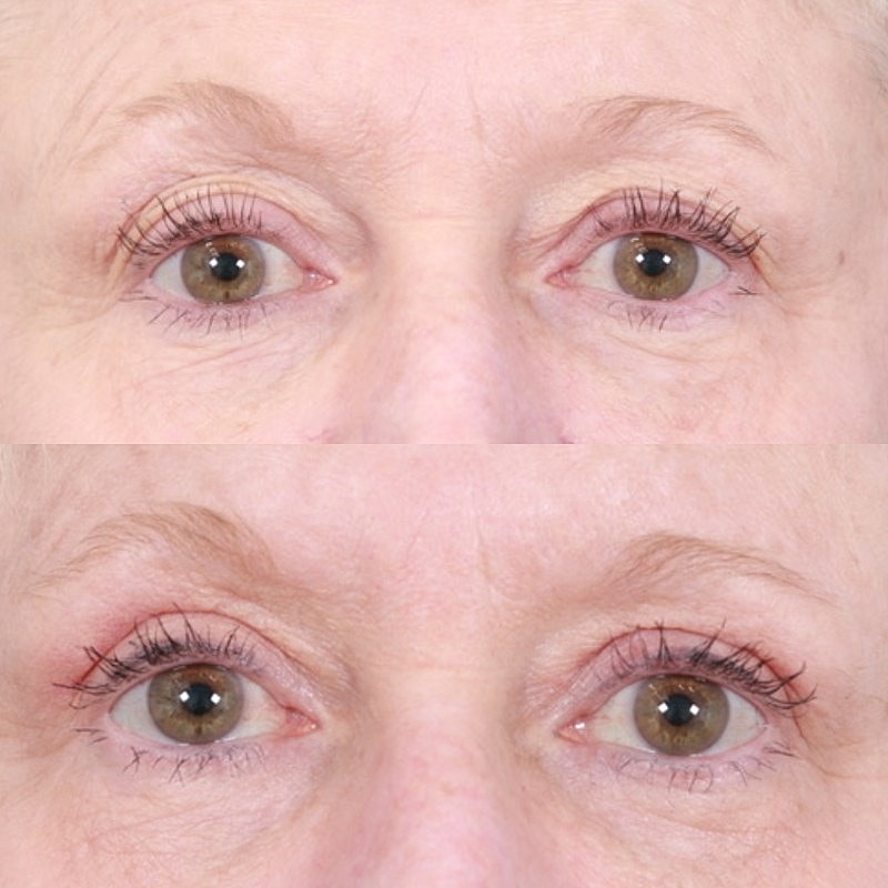 Blepharoplasty Before & After