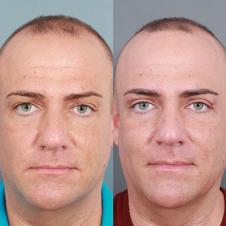 Blepharoplasty Before & After