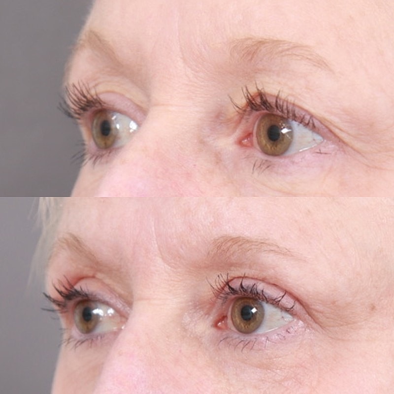 Blepharoplasty Before & After