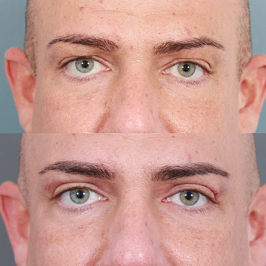 Blepharoplasty Before & After