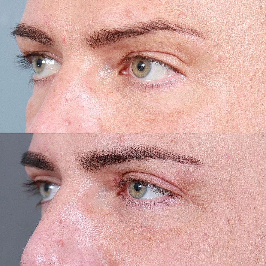 Blepharoplasty Before & After