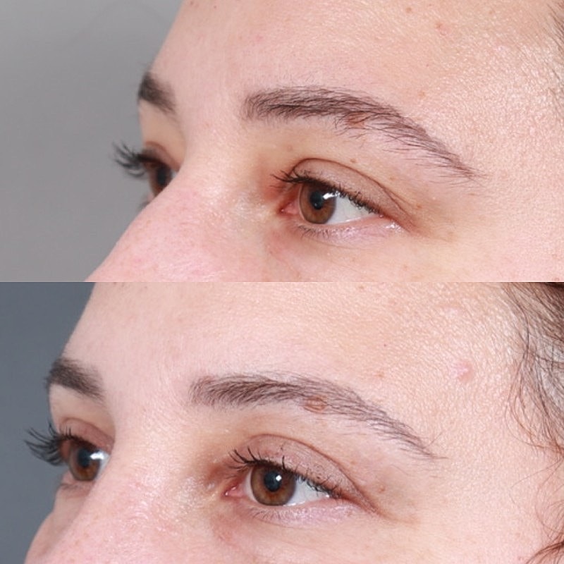 Blepharoplasty Before & After