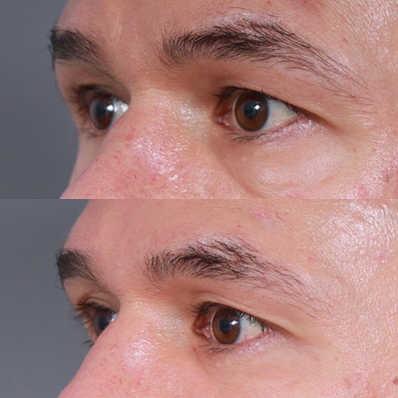 Blepharoplasty Before & After