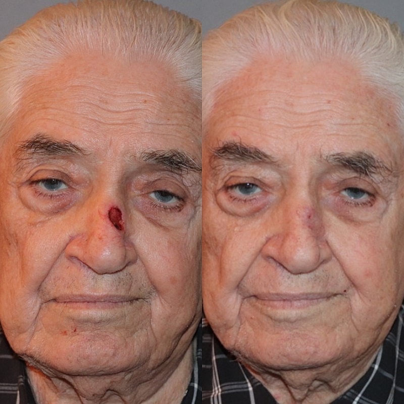 Mohs Before & After