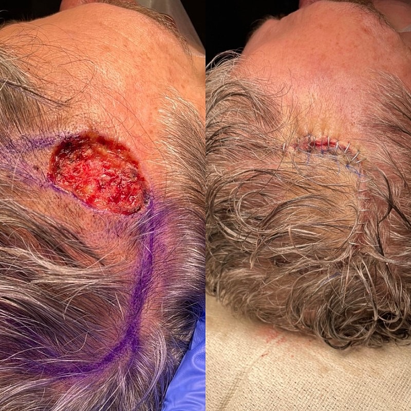 Mohs Before & After
