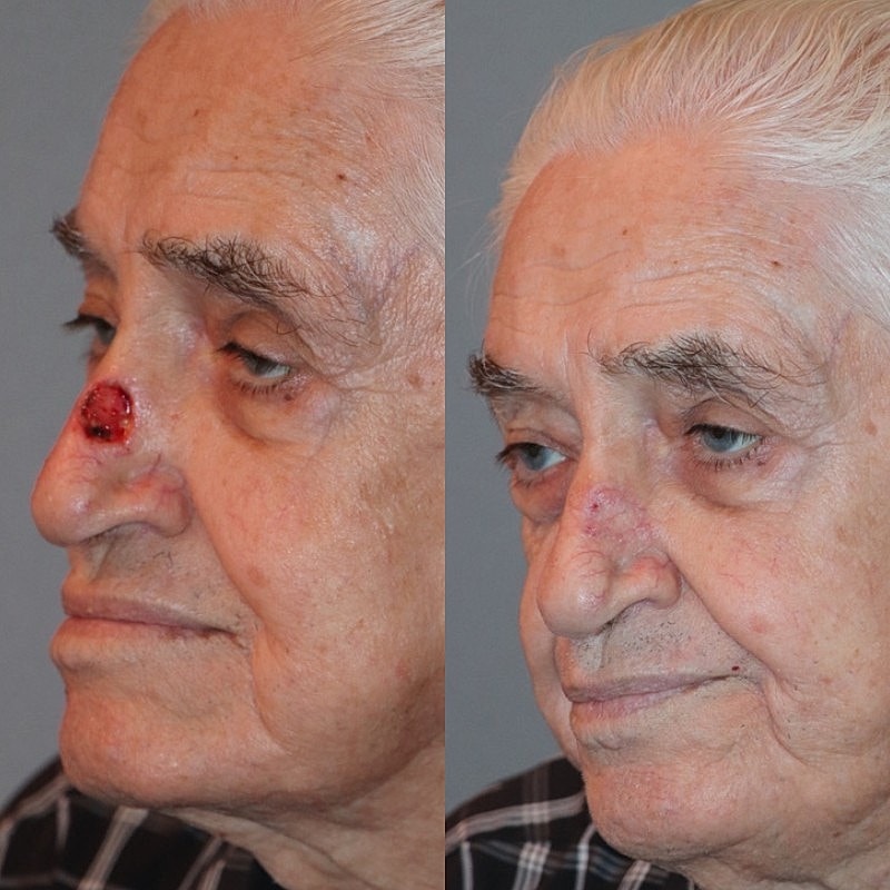 Mohs Before & After
