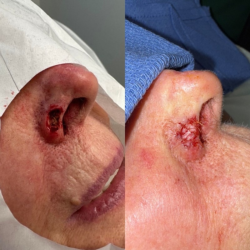 Mohs Before & After