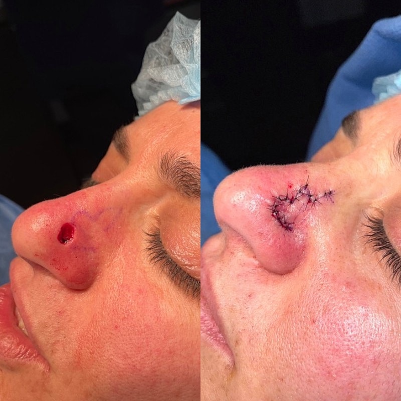 Mohs Before & After