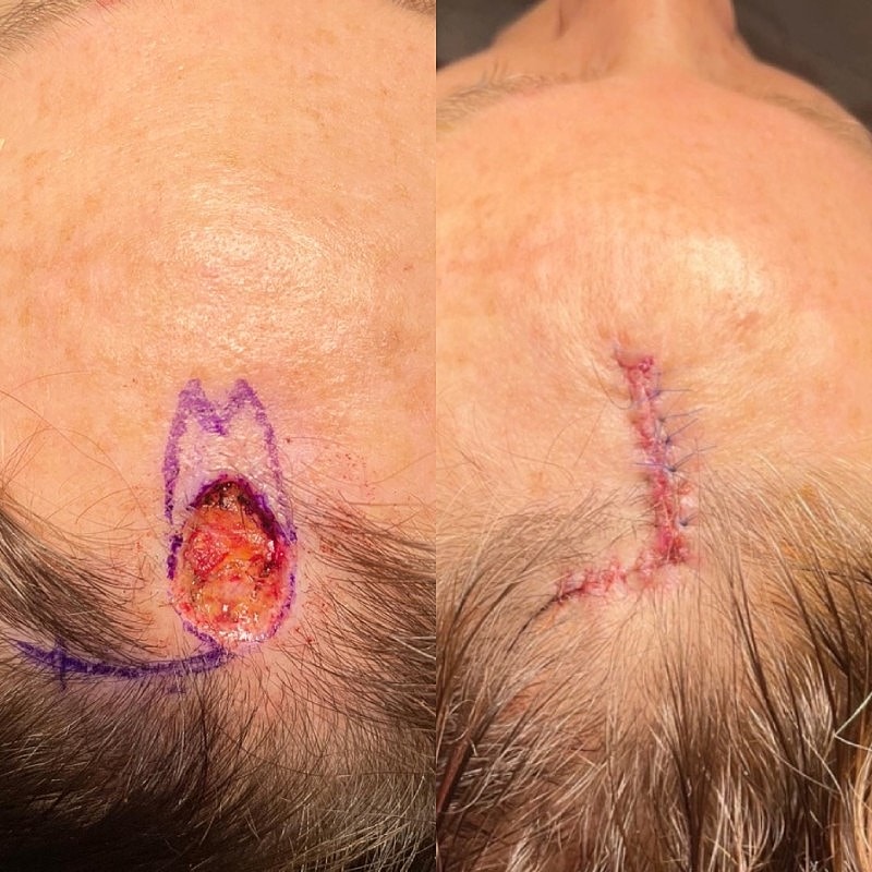 Mohs Before & After